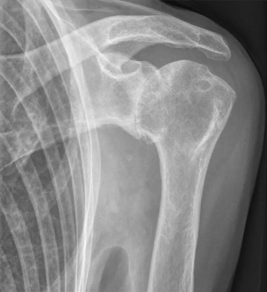Radiographie de face d'une épaule arthrosique : interligne articulaire disparu et sclérose de l'os sous-chondral