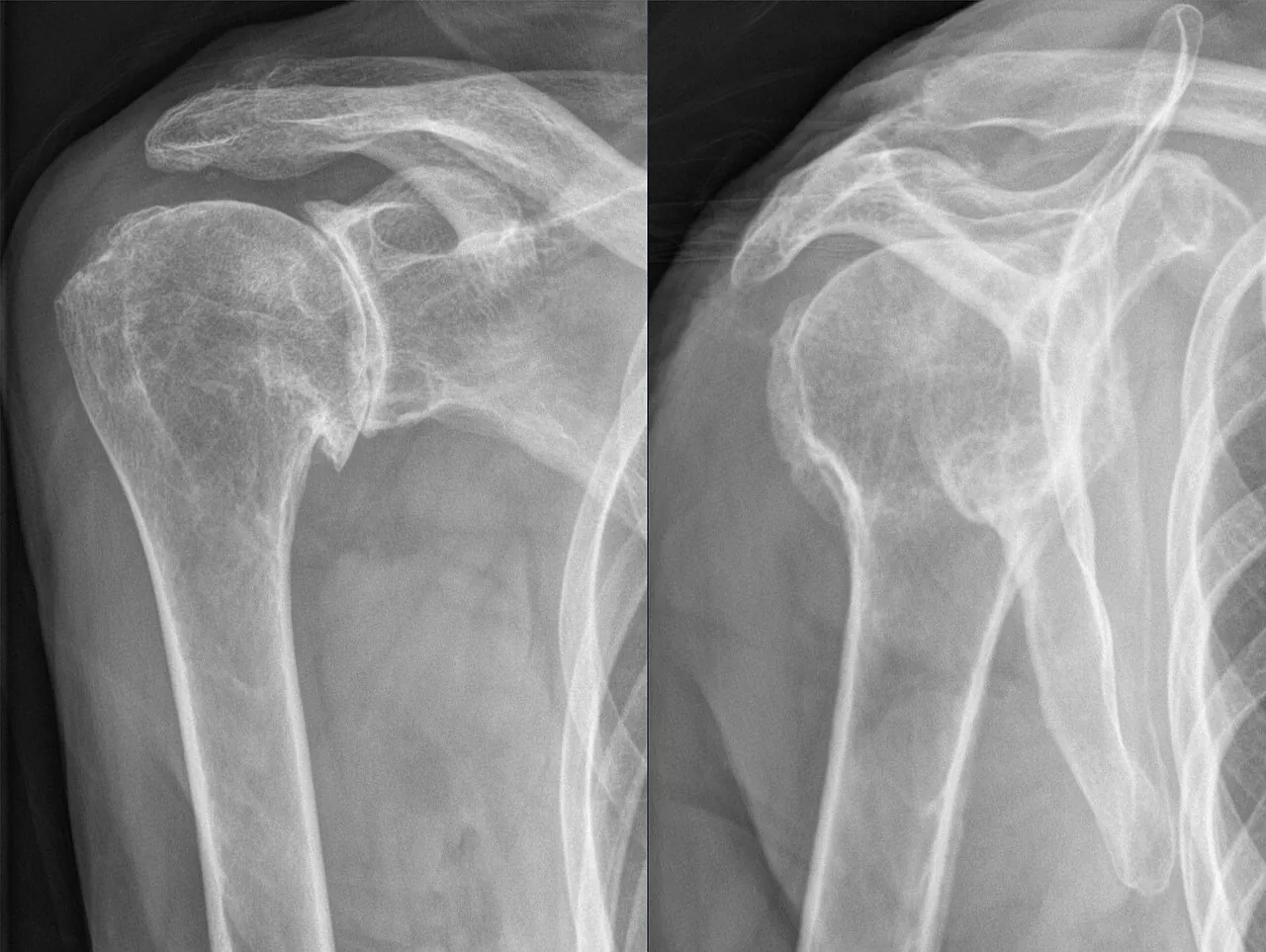 Deux radiographies d'une épaule arthrosique montrant un ostéophyte et une géode