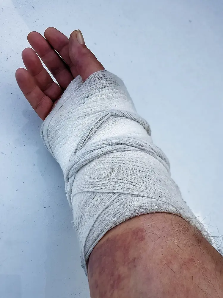 Avant-bras et poignet immobilisés par une attelle plâtrée maintenue par une bande, doigts libres