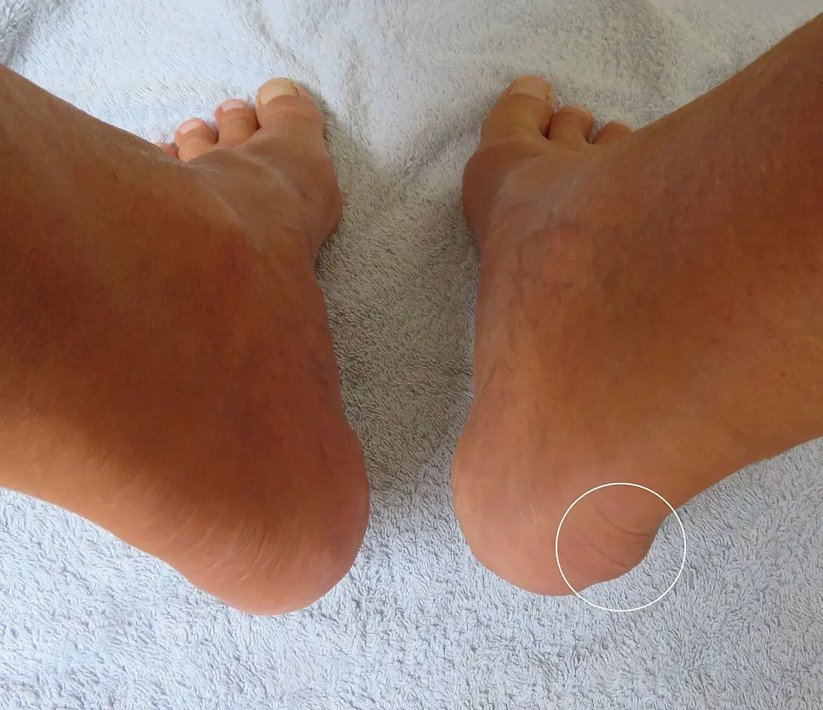 Deux talons vus de dos : petite bosse à l'arrière du talon droit, talon gauche normal pour comparaison