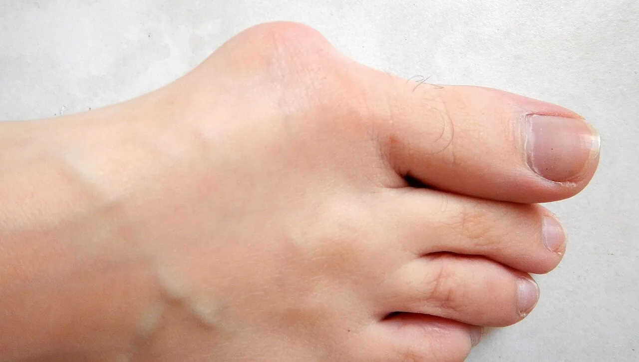 Pieds nus montrant un gros orteil dévié vers les autres orteils avec une bosse à sa base