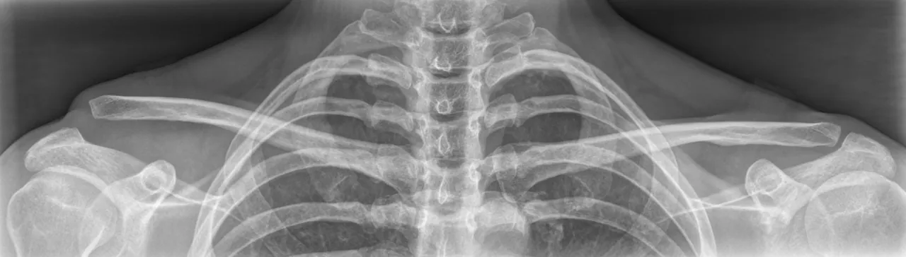 Radiographie de la ceinture scapulaire montrant une luxation acromio-claviculaire droite