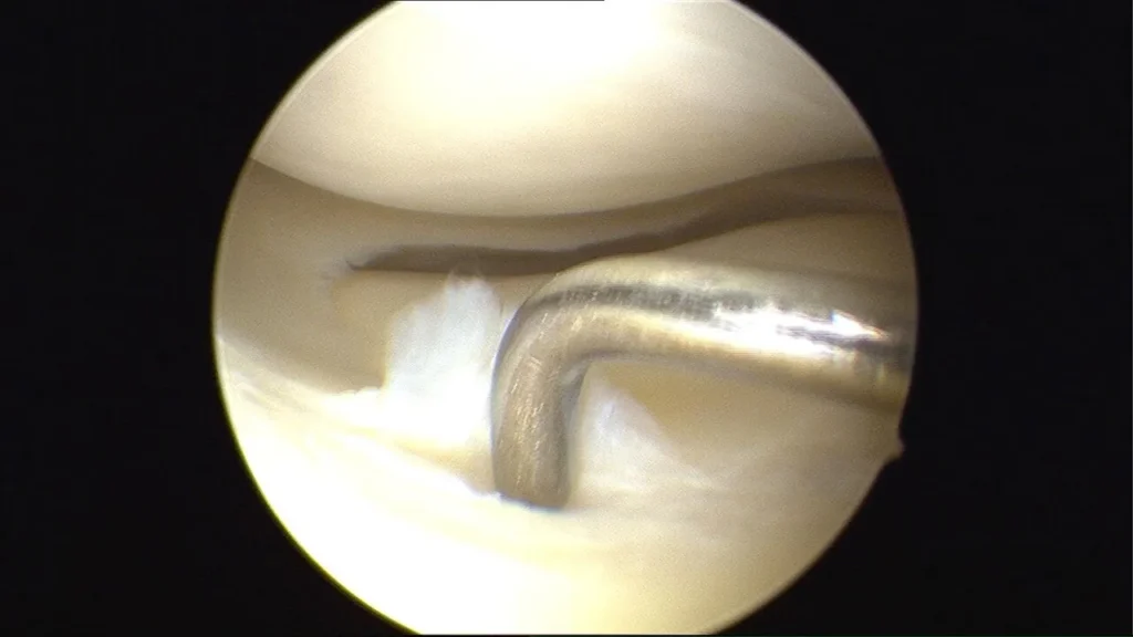 Vue arthroscopique du genou : déchirure de la corne antérieure du ménisque externe désignée par un crochet palpeur