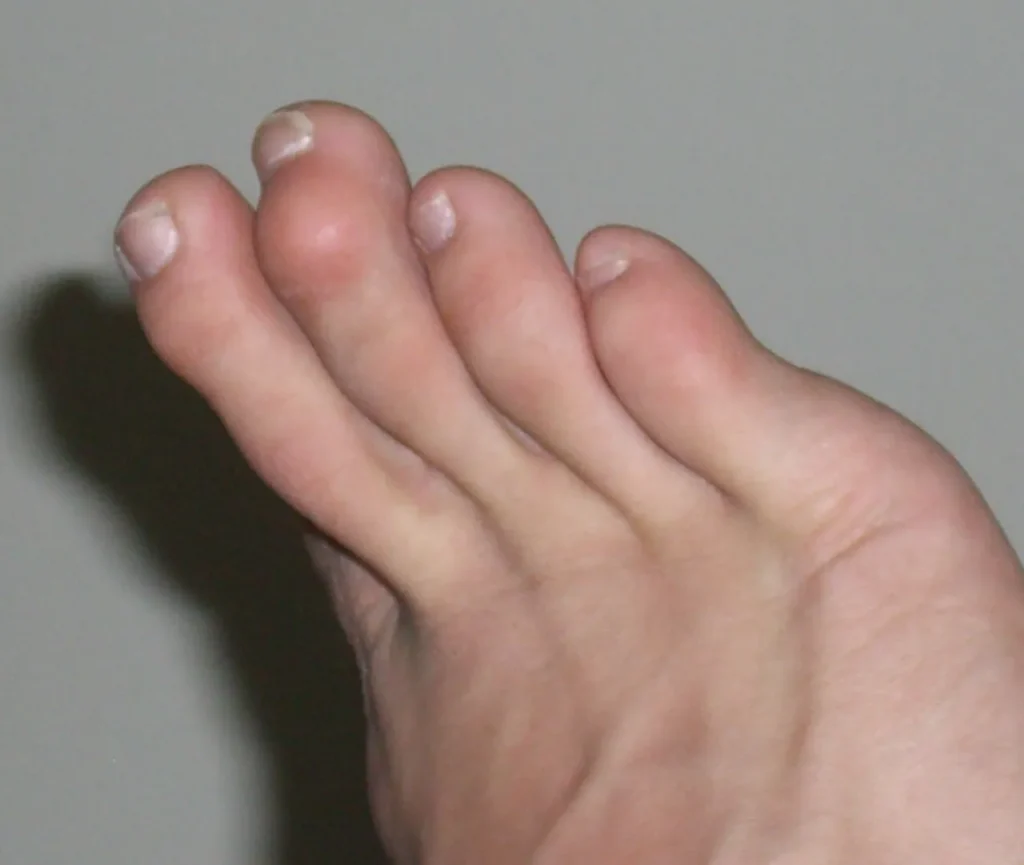 Pied nu dont le troisième orteil présente une flexion de sa dernière phalange (orteil en maillet)