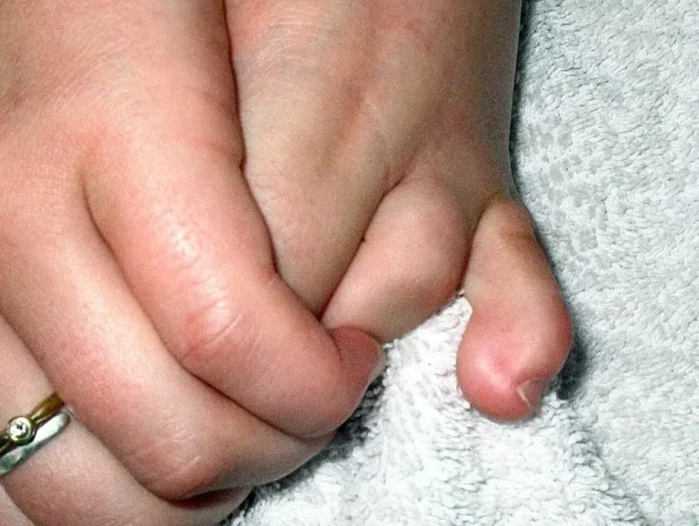 Pied nu vu de profil : le troisième orteil est replié vers le bas en forme de marteau