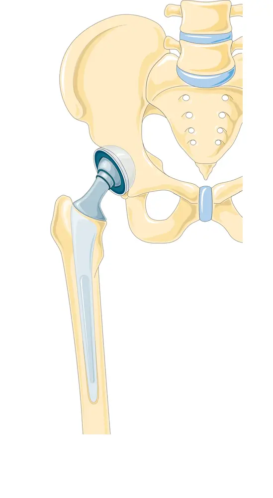 Schéma d'une prothèse totale de hanche implantée dans le bassin et le fémur