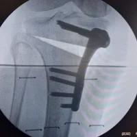 OSTEOTOMIES DU GENOU