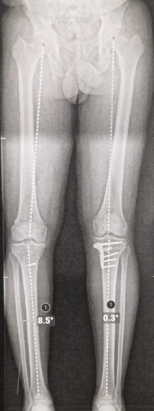Patient opéré d'ostéotomie tibiale de valgisation à sa jambe gauche