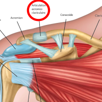 LUXATION ACROMIOCLAVICULAIRE