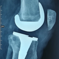 PROTHÈSE DU GENOU (PTG)