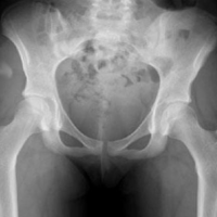 Ostéotomie périacétabulaire (OPA)