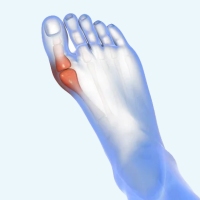 L&rsquo;HALLUX VALGUS