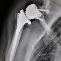 PROTHÈSE DE L&rsquo;ÉPAULE