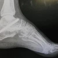 L&rsquo;ARTHRODÈSE DE LA CHEVILLE
