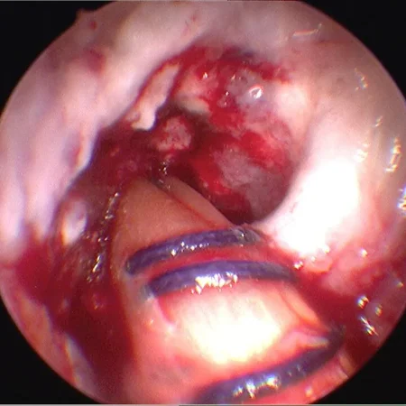 Vue arthroscopique pendant une ligamentoplastie du LCA : greffon de tendon replié en faisceaux tiré dans le tunnel osseux