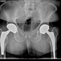 Reprise de prothèse totale de hanche