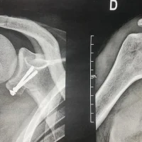 INSTABILITÉ DE L&rsquo;ÉPAULE